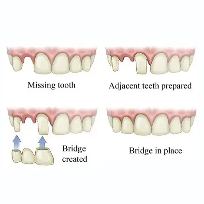 graphic of a dental bridge | same day crowns in glendale az