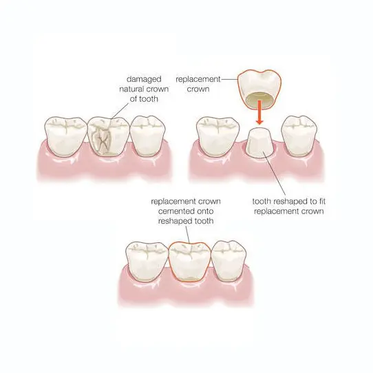 graphic of a dental crown | same day crowns in glendale az
