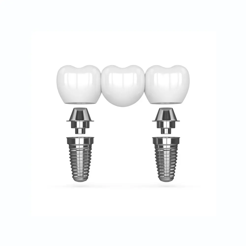 dental implants glendale az | multi tooth implant bridge