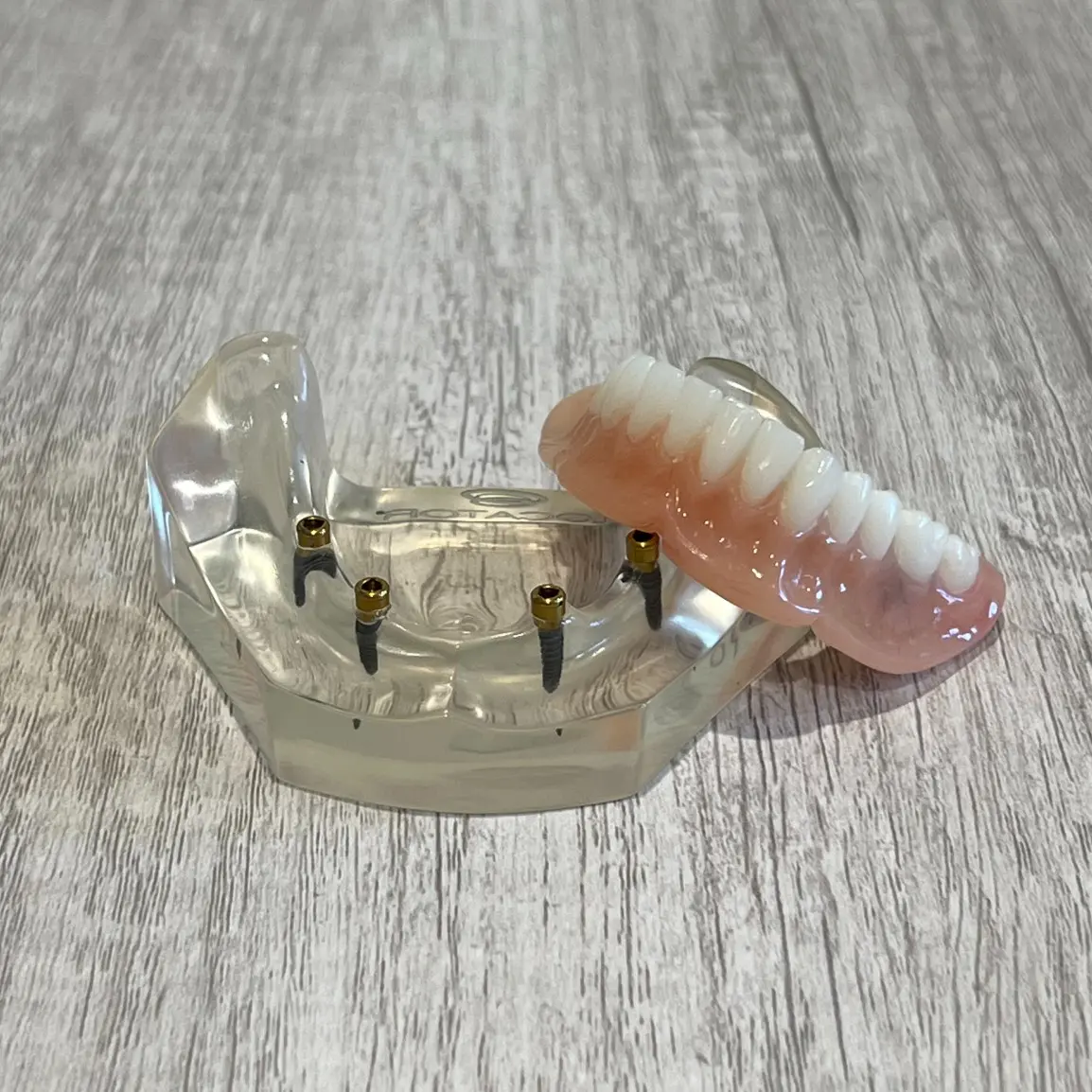 dental implants glendale az | snap in implant dentures