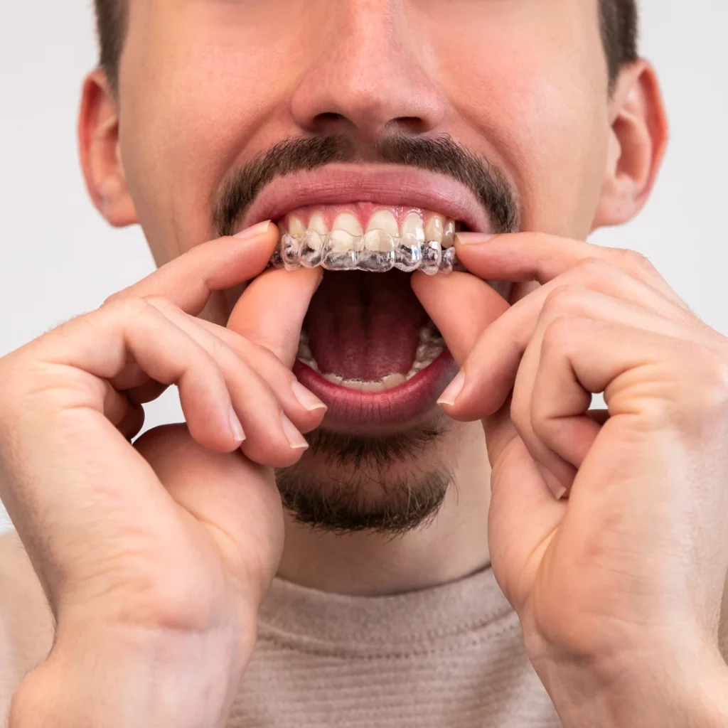 man putting on suresmile clear aligners to straighten teeth