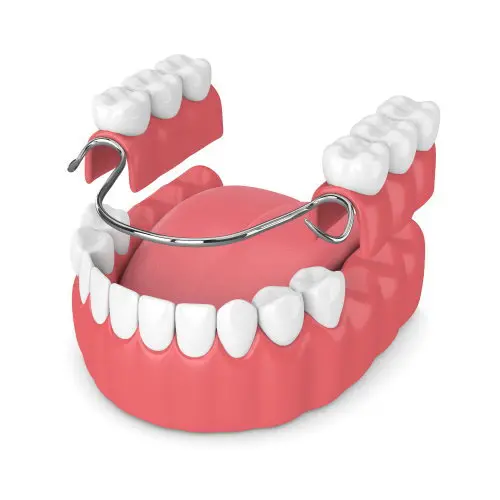 cast metal partial dentures glendale az
