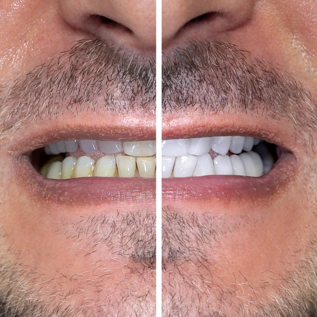 before and after professional teeth whitening at dentist