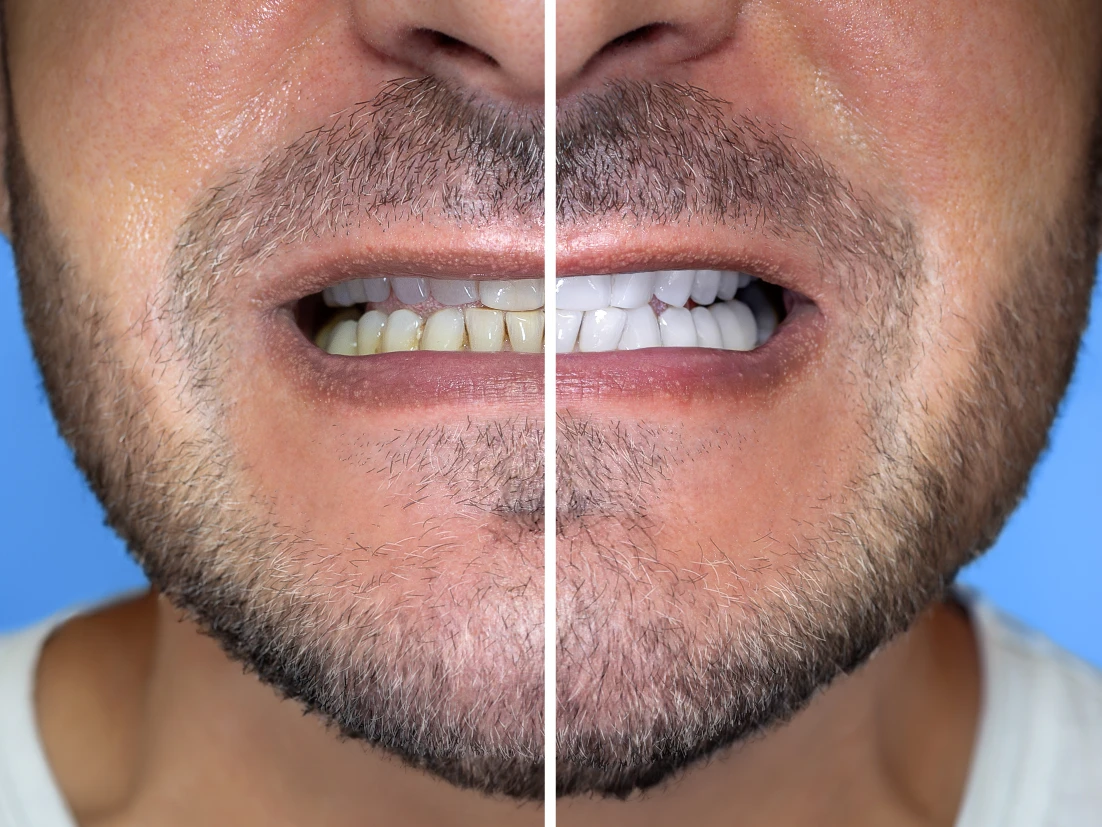 before and after professional teeth whitening glendale az